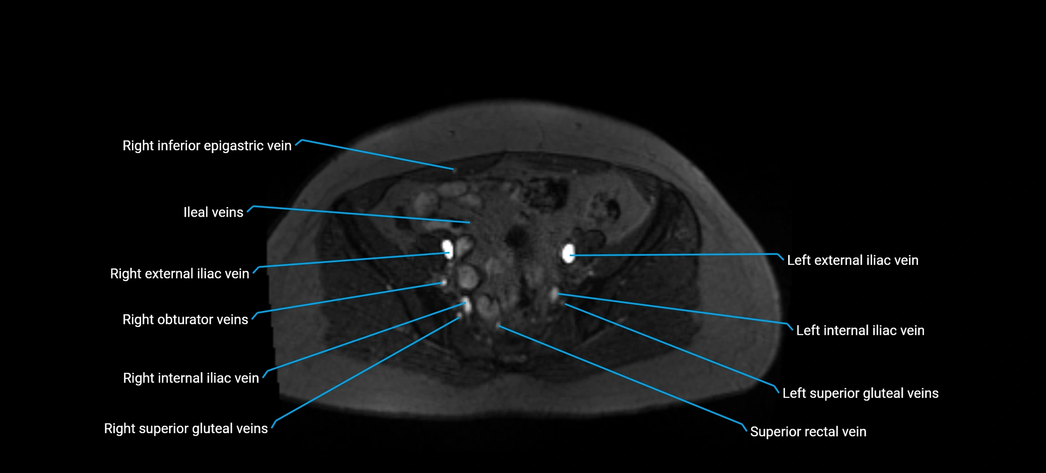MRV abdomen pelvis & lower limb axial cross sectional anatomy labelled MRI image 144 (1).webp